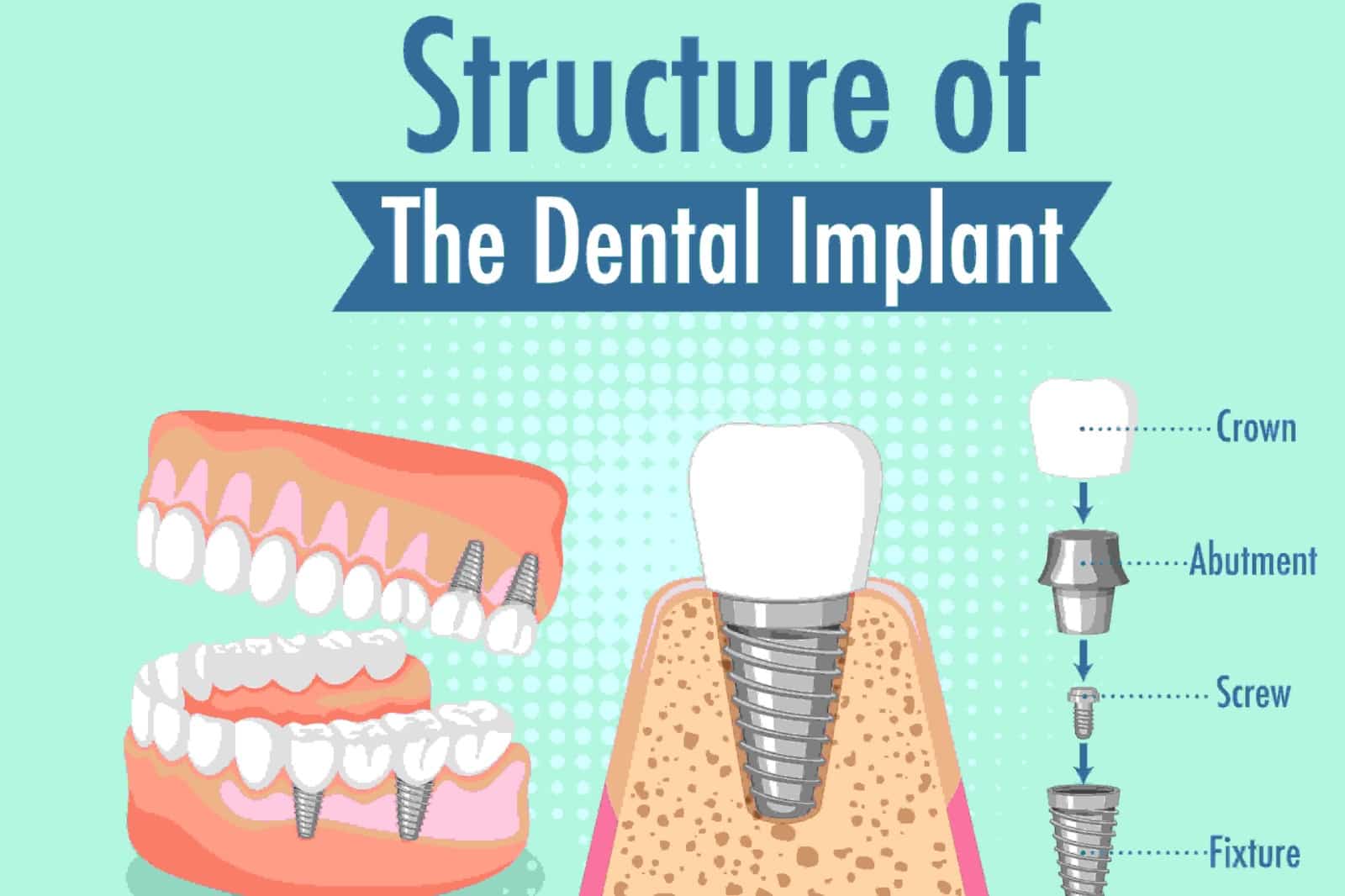 Dental Implants: A Revolutionary Solution for Restoring Missing Teeth