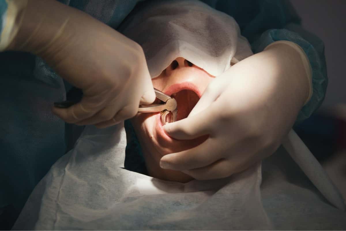 Wisdom Tooth Removal: Understanding the Procedure and its Benefits