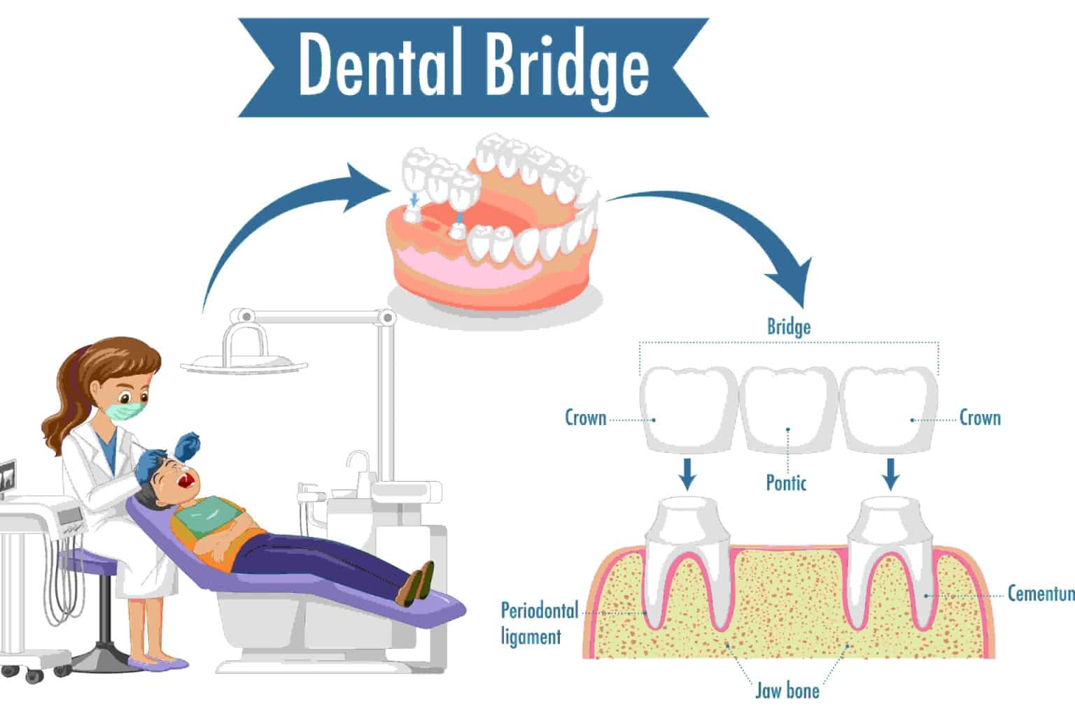 dental bridges and crowns, dental brige in gaur city noida extension