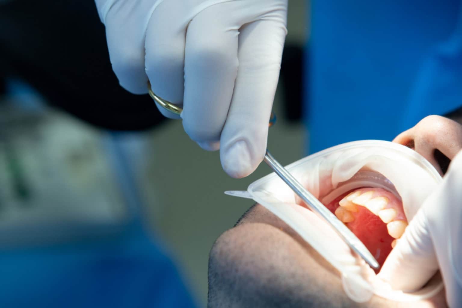 extraction in gaur city noida extension, tooth extraction treatment gaur city noida extension