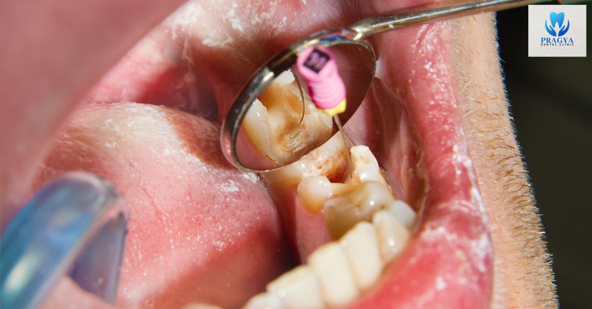 Why Root Canal Treatment Is Not as Painful as You Think