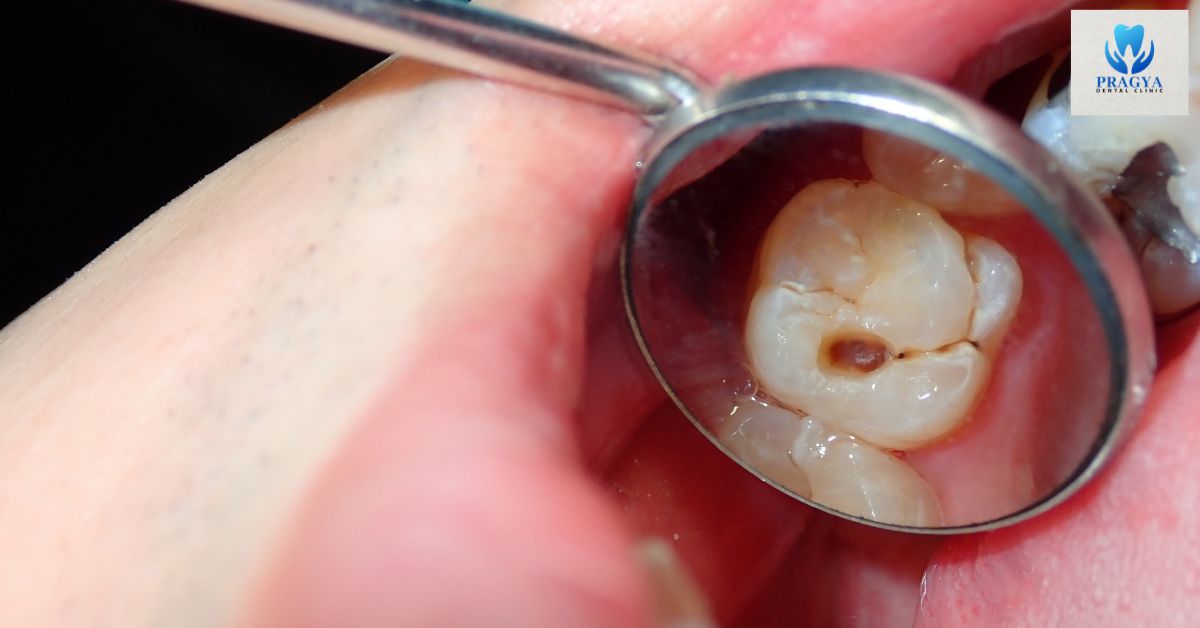 Understanding Tooth Cavities: Causes, Symptoms & Treatment